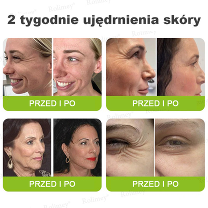 🎁Rolimey® krem przeciwzmarszczkowy (z peptydami typu Botox i Vita-A Retinol) – ostatni dzień promocji, 70% TANIEJ ⏰