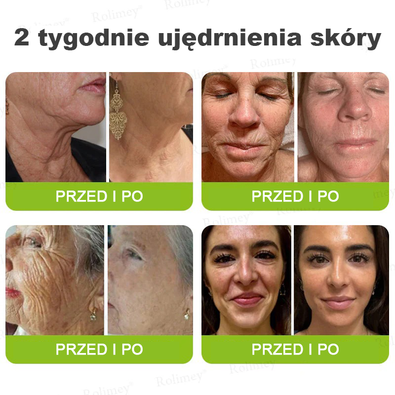 🎁Rolimey® krem przeciwzmarszczkowy (z peptydami typu Botox i Vita-A Retinol) – ostatni dzień promocji, 70% TANIEJ ⏰