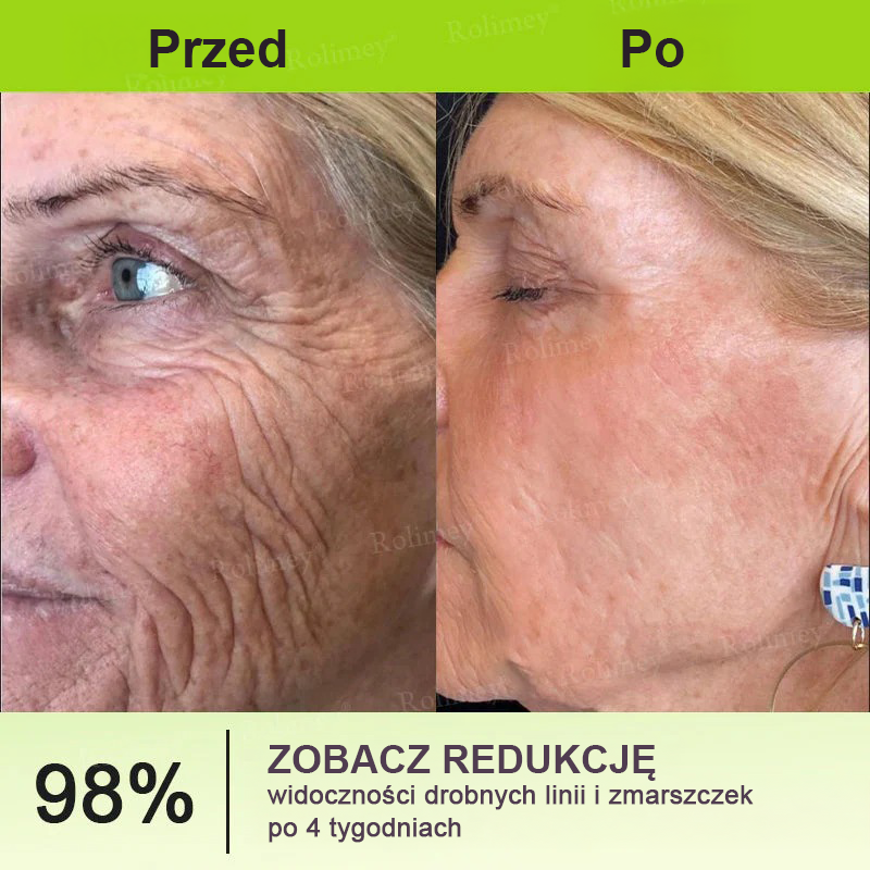 🎁Rolimey® krem przeciwzmarszczkowy (z peptydami typu Botox i Vita-A Retinol) – ostatni dzień promocji, 70% TANIEJ ⏰