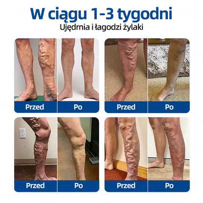 Healrize® VeinTarget Plaster z mikroigłami |⚡ Natychmiastowa ulga, długotrwałe efekty
